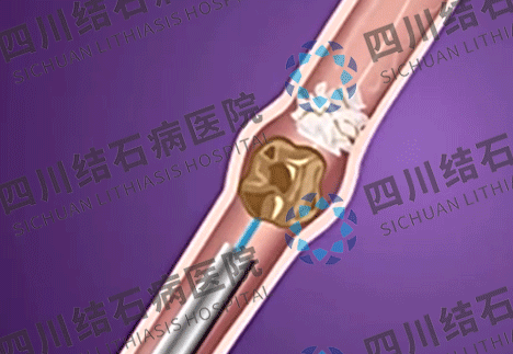 四川肾结石医院：肾结石引发肾绞痛时，为什么还会伴随恶心呕吐?(图5)