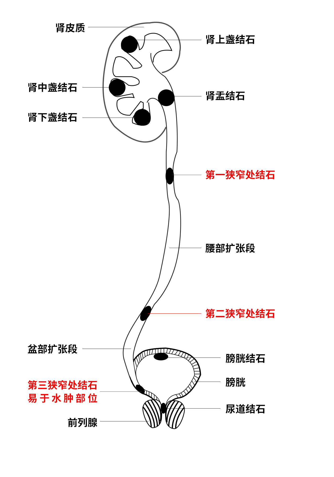 成都肾结石专科医院：“传说”多喝水就能排肾结石，为什么有些人却越喝越痛？(图2)