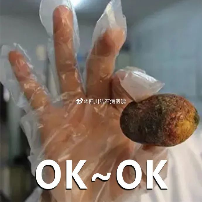 四川肾结石专科医院科普:肾结石患者生活饮食指南大揭秘(图3) 四川肾结石专科医院科普:肾结石患者生活饮食指南大揭秘(图3)
