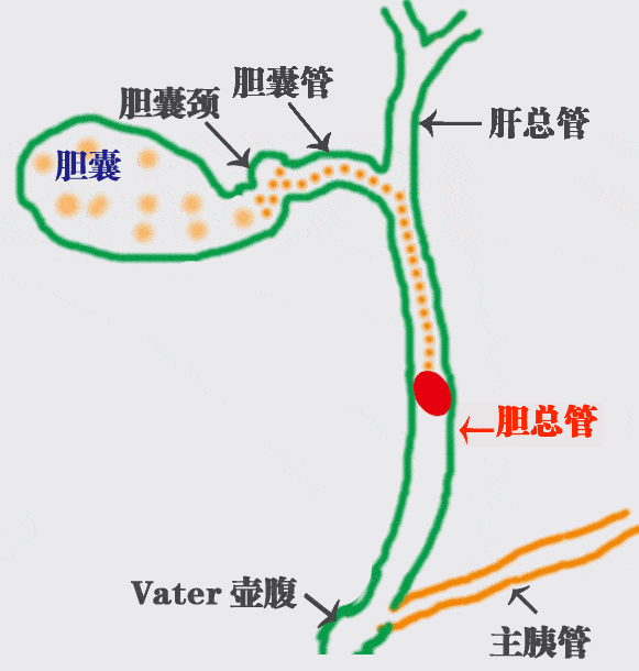 胆囊结石排石乱象：这些热门方法真的有效吗?肝胆专家为您揭开真相！【四川胆结石专科医院】(图4)