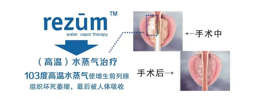 告别排尿困扰！国际新技术为前列腺增生患者带来福音【四川瑞梦热蒸汽治疗前列腺医院】(图3)