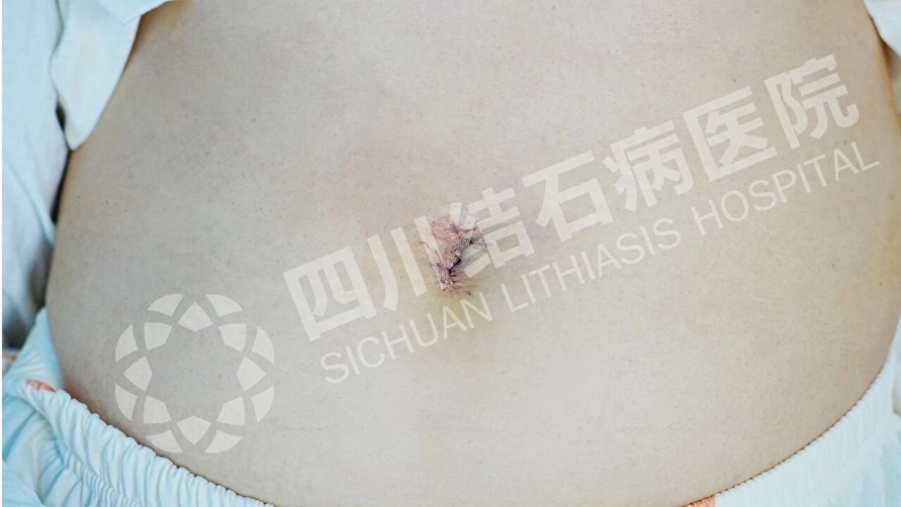 从肚脐解除胆结石困扰:经脐隐瘢痕技术助患者重塑健康与自信【四川结石病医院】(图1) 从肚脐解除胆结石困扰:经脐隐瘢痕技术助患者重塑健康与自信【四川结石病医院】(图1)