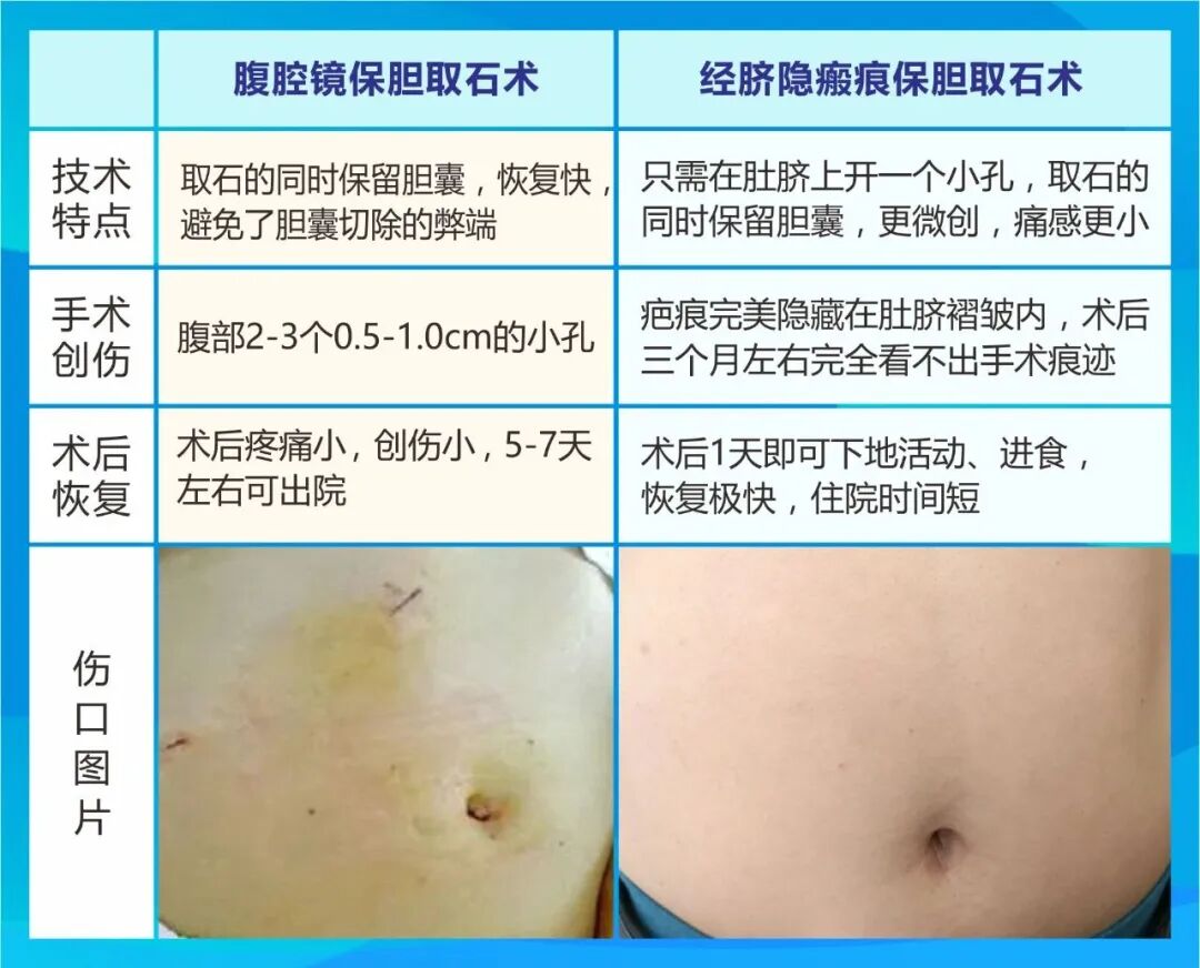 从肚脐解除胆结石困扰:经脐隐瘢痕技术助患者重塑健康与自信【四川结石病医院】(图3) 从肚脐解除胆结石困扰:经脐隐瘢痕技术助患者重塑健康与自信【四川结石病医院】(图3)