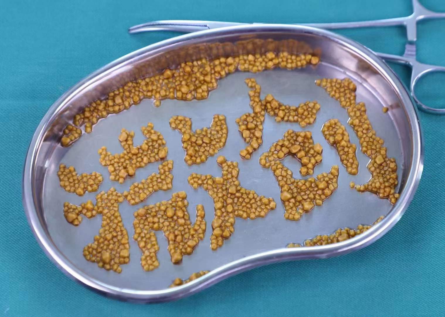 体检发现“胆囊壁增厚”？别慌！肝胆外科专家教你科学应对(图4)