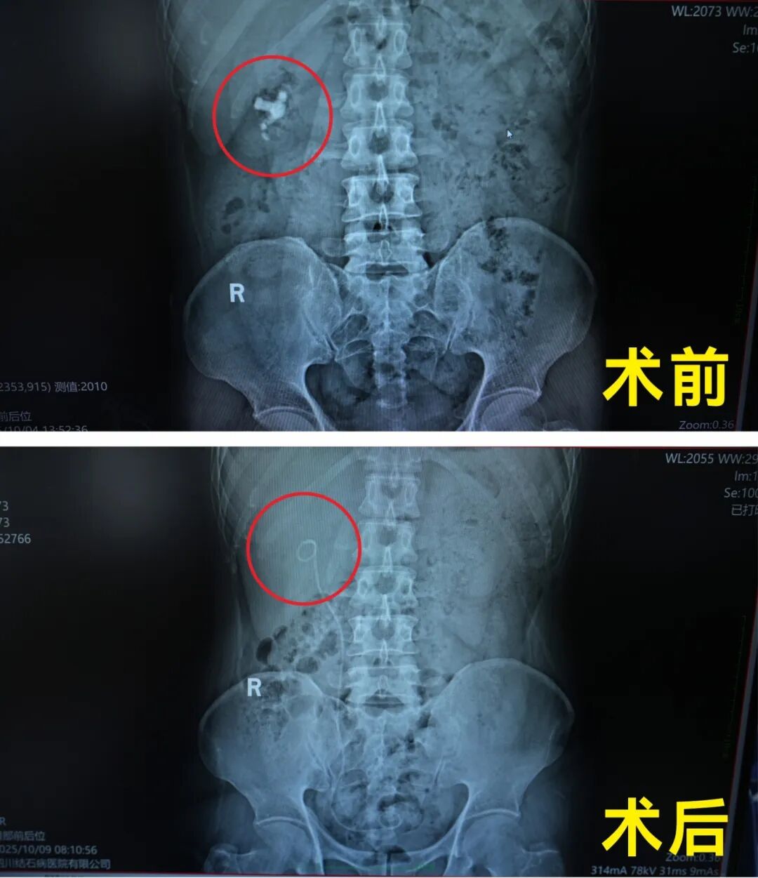 2025年度|四川结石病医院泌尿外科:锚定精准医疗,深耕亚专业建设(图3) 2025年度|四川结石病医院泌尿外科:锚定精准医疗,深耕亚专业建设(图3)