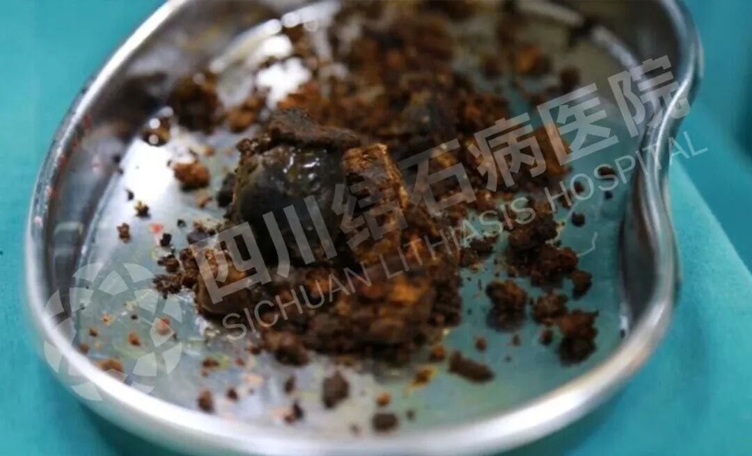 顿顿肥肉不忌口?七旬老兵体内取出鸭蛋大结石【四川结石病医院】(图2) 顿顿肥肉不忌口?七旬老兵体内取出鸭蛋大结石【四川结石病医院】(图2)