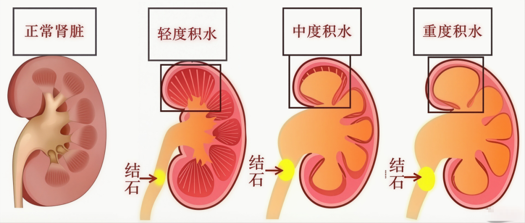 ICU抢救10天!温岚的遭遇敲响警钟:肾结石要早治【四川肾结石医院】(图2) ICU抢救10天!温岚的遭遇敲响警钟:肾结石要早治【四川肾结石医院】(图2)