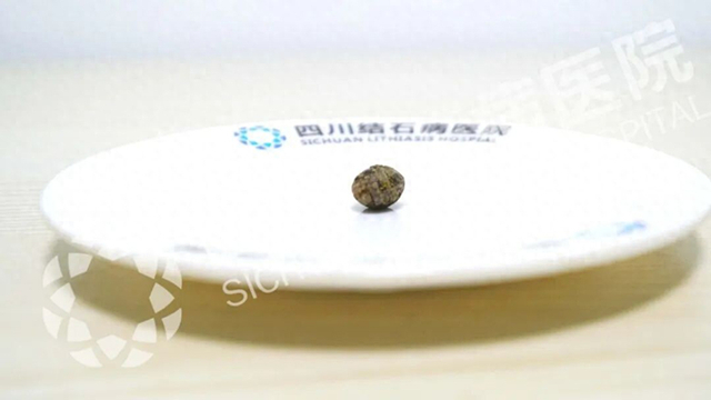 不用带T管！无管化手术实现快速康复【四川保胆取石医院】(图1)