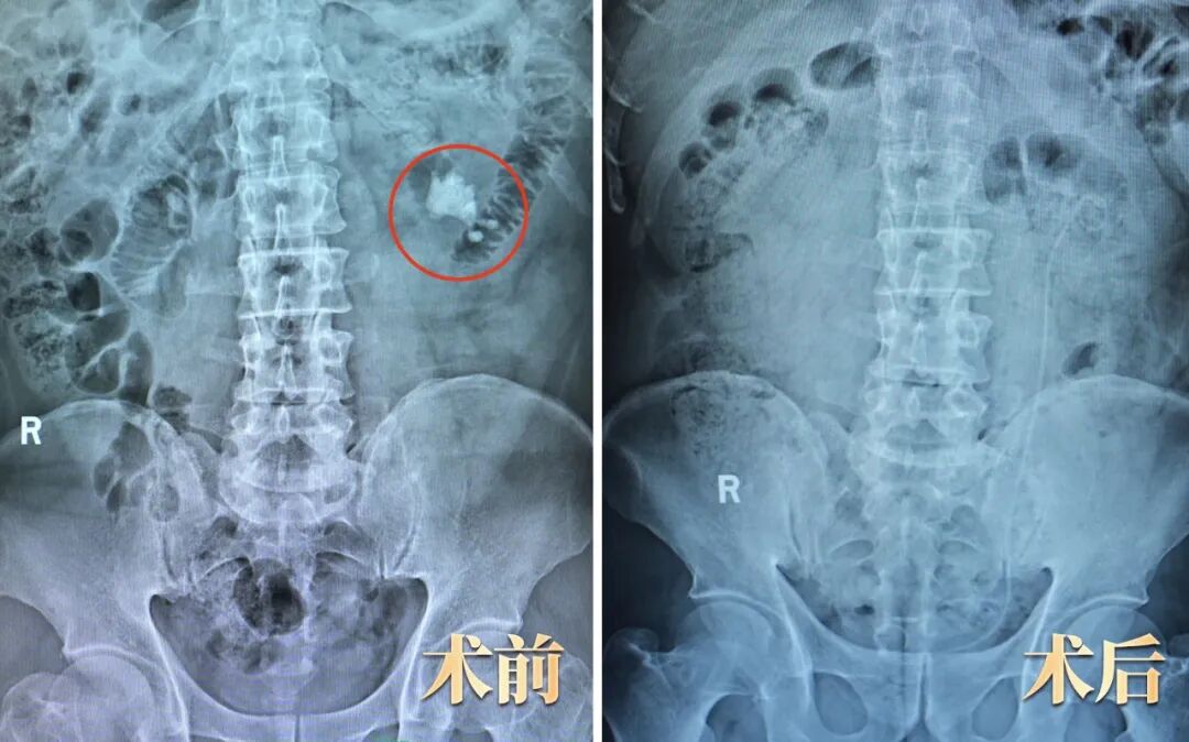 外院两次手术未能“断根”，四川结石病医院“一招清石”(图1)